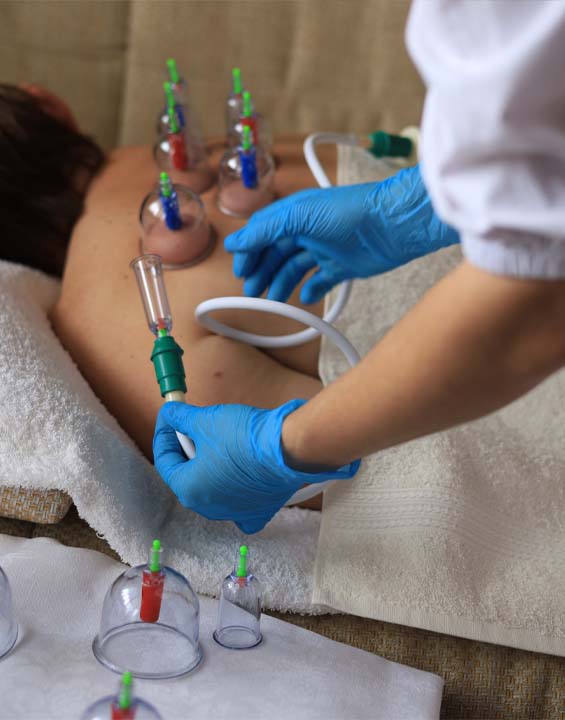 Hijama / Cupping Therapy